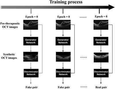 Predicting OCT images of short-term response to anti-VEGF treatment for retinal vein occlusion using generative adversarial network